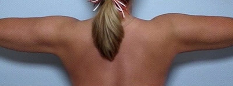 Arm Contouring Before & After Gallery - Patient 259886 - Image 2