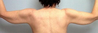 Arm Contouring Before & After Gallery - Patient 193928 - Image 1