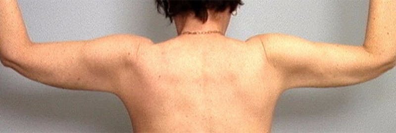 Arm Contouring Before & After Gallery - Patient 193928 - Image 2