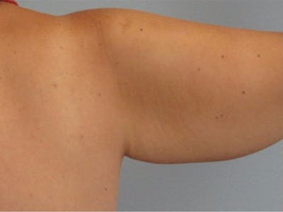 Arm Contouring Before & After Gallery - Patient 290214 - Image 1
