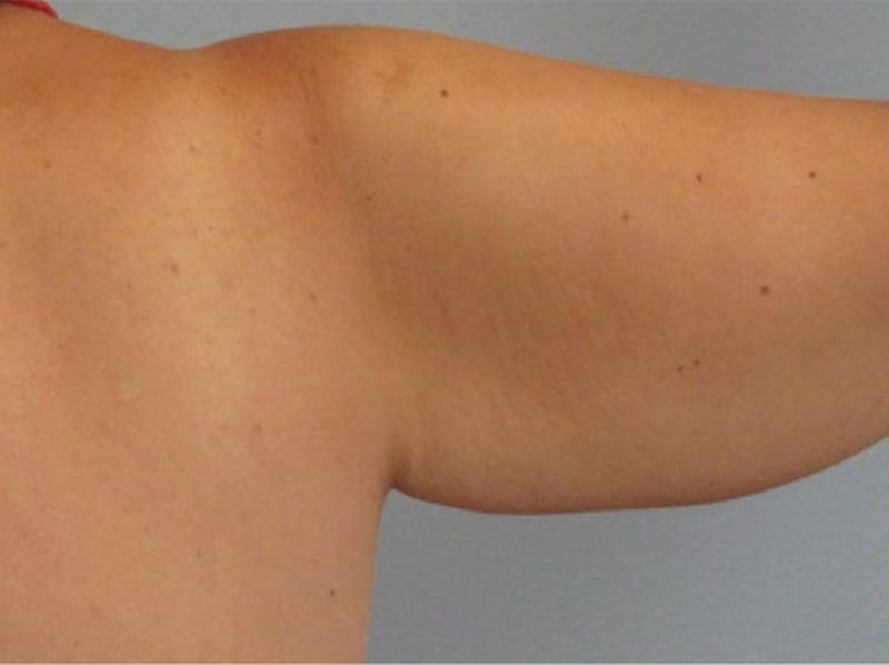 Arm Contouring Before & After Gallery - Patient 290214 - Image 1