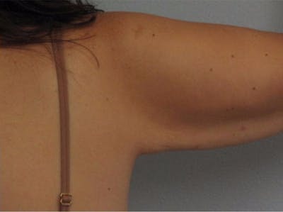 Arm Contouring Before & After Gallery - Patient 290214 - Image 2