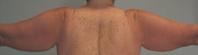 Arm Contouring Before & After Gallery - Patient 617567 - Image 1