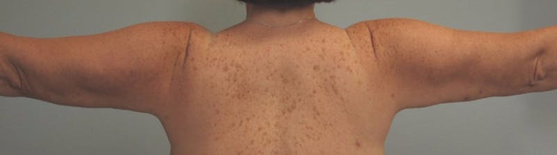 Arm Contouring Before & After Gallery - Patient 617567 - Image 2