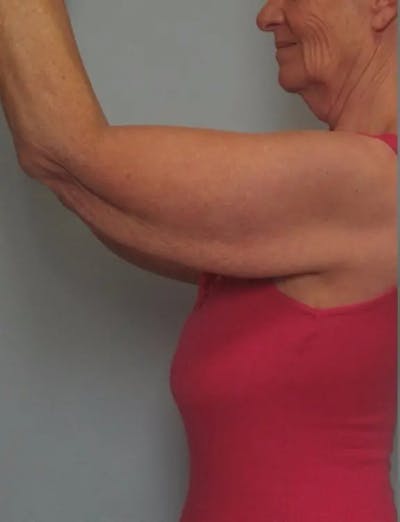 Arm Contouring Before & After Gallery - Patient 337499 - Image 1
