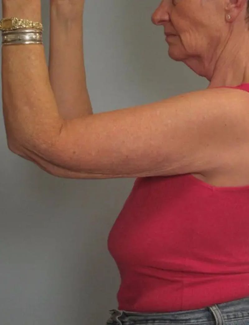 Arm Contouring Before & After Gallery - Patient 337499 - Image 2
