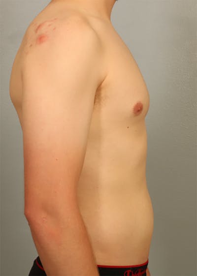 Emsculpt Before & After Gallery - Patient 275202 - Image 1