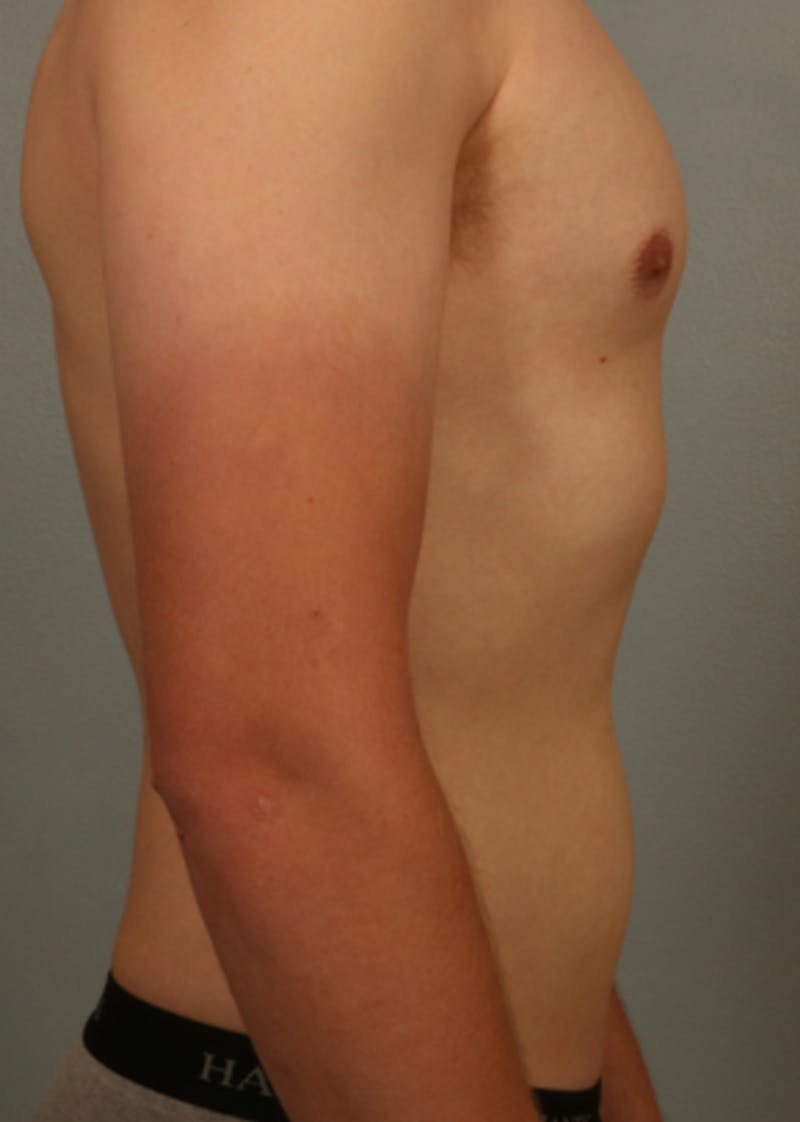 Emsculpt Before & After Gallery - Patient 275202 - Image 2