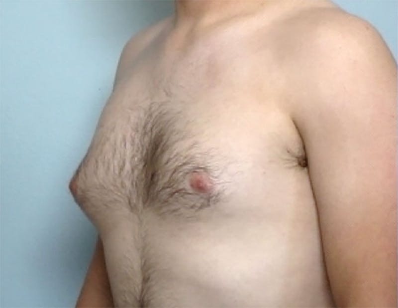 Gynecomastia Before & After Gallery - Patient 179215 - Image 1
