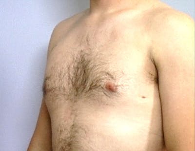 Gynecomastia Before & After Gallery - Patient 179215 - Image 2