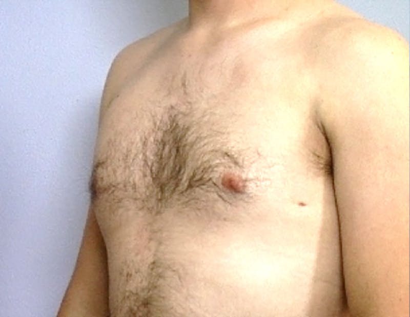 Gynecomastia Before & After Gallery - Patient 179215 - Image 2