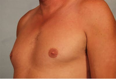 Gynecomastia Before & After Gallery - Patient 196553 - Image 1