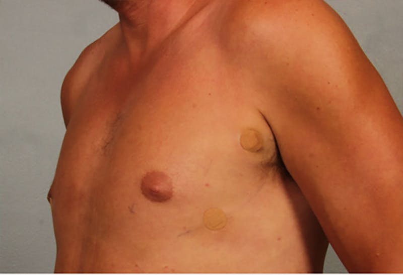 Gynecomastia Before & After Gallery - Patient 196553 - Image 2