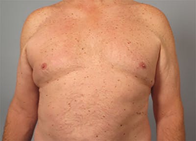 Gynecomastia Before & After Gallery - Patient 136827 - Image 1