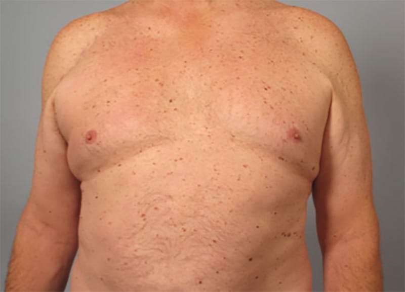 Gynecomastia Before & After Gallery - Patient 136827 - Image 1