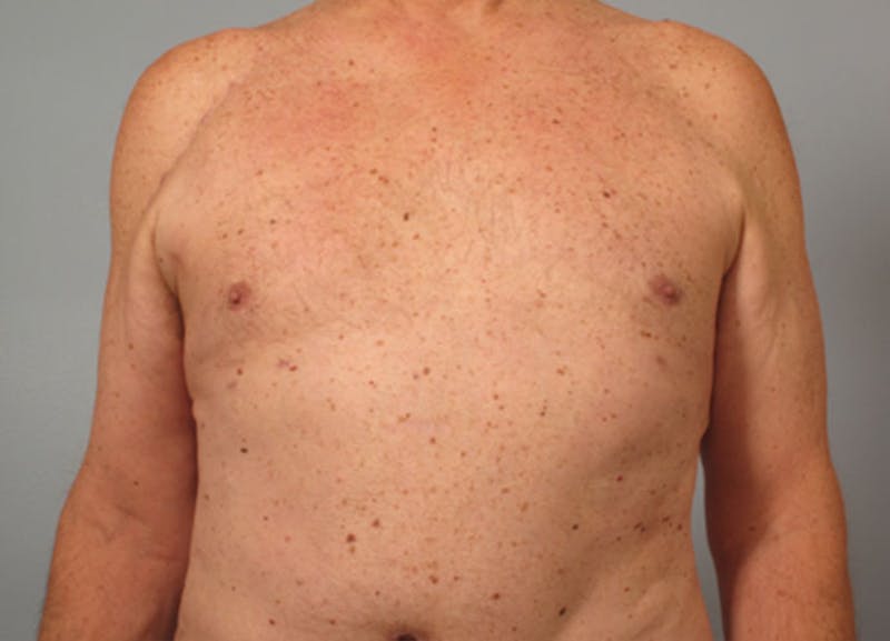 Gynecomastia Before & After Gallery - Patient 136827 - Image 2