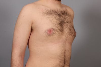 Gynecomastia Before & After Gallery - Patient 223791 - Image 1