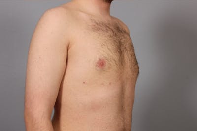 Gynecomastia Before & After Gallery - Patient 223791 - Image 2