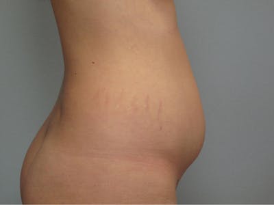 Liposuction Before & After Gallery - Patient 675755 - Image 1