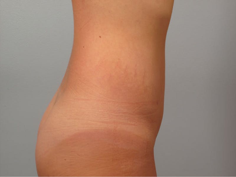 Liposuction Before & After Gallery - Patient 675755 - Image 2