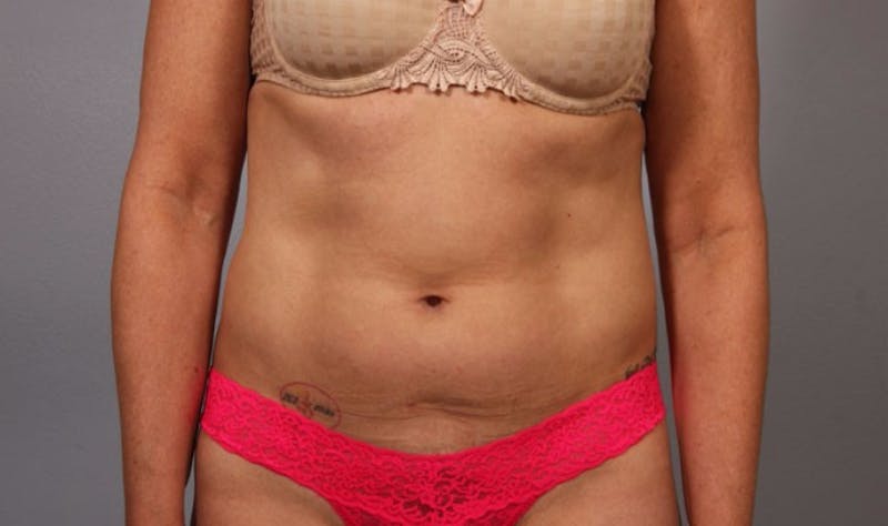 Liposuction Before & After Gallery - Patient 233654 - Image 1