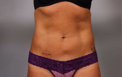 Liposuction Before & After Gallery - Patient 233654 - Image 2