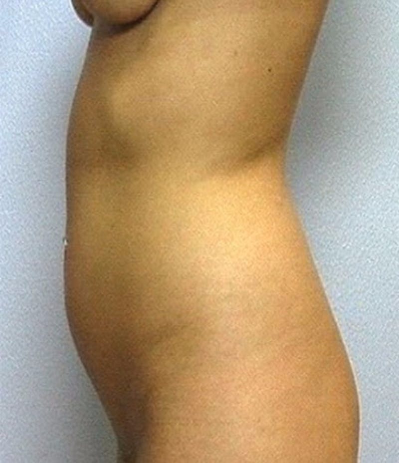 Liposuction Before & After Gallery - Patient 733574 - Image 1