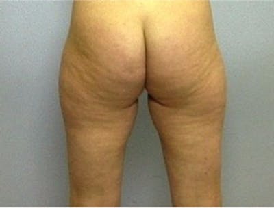 Liposuction Before & After Gallery - Patient 194169 - Image 1
