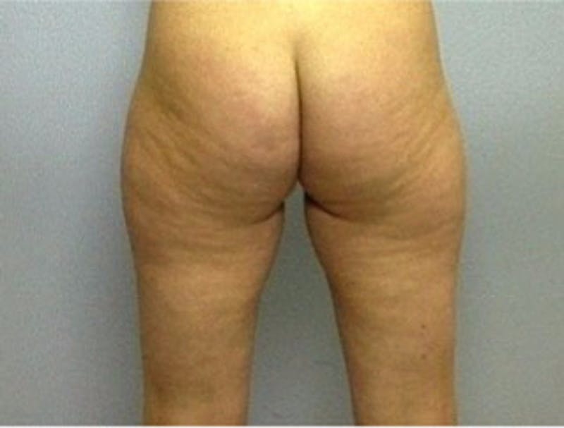 Liposuction Before & After Gallery - Patient 194169 - Image 1