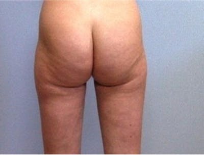 Liposuction Before & After Gallery - Patient 194169 - Image 2