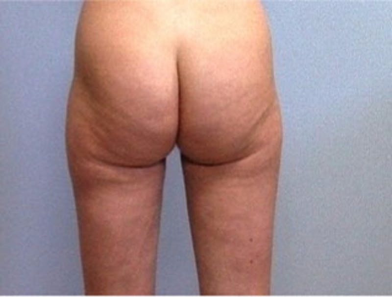 Liposuction Before & After Gallery - Patient 194169 - Image 2