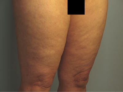 Liposuction Before & After Gallery - Patient 387408 - Image 1