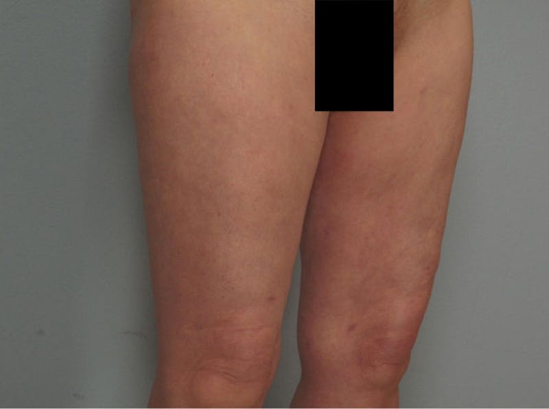 Liposuction Before & After Gallery - Patient 387408 - Image 2