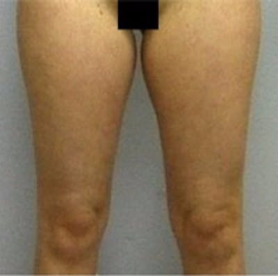 Liposuction Before & After Gallery - Patient 357002 - Image 1