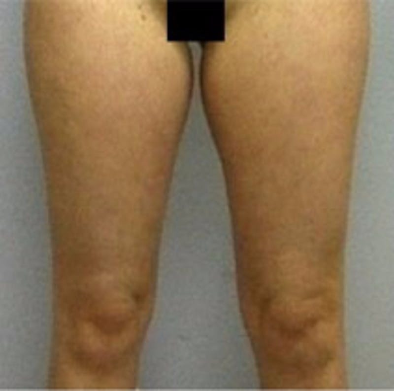 Liposuction Before & After Gallery - Patient 357002 - Image 1