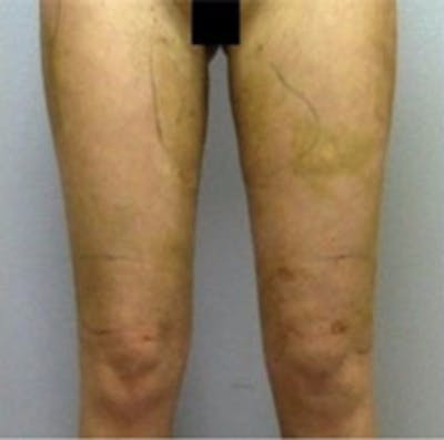 Liposuction Before & After Gallery - Patient 357002 - Image 2
