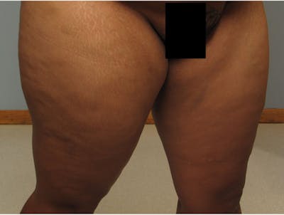 Liposuction Before & After Gallery - Patient 255006 - Image 1