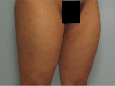 Liposuction Before & After Gallery - Patient 255006 - Image 2