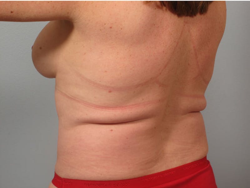 Liposuction Before & After Gallery - Patient 293106 - Image 1