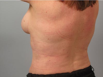 Liposuction Before & After Gallery - Patient 293106 - Image 2
