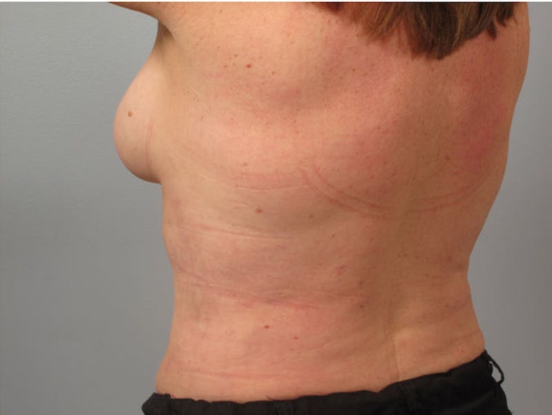 Liposuction Before & After Gallery - Patient 293106 - Image 2