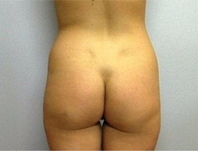 Liposuction Before & After Gallery - Patient 337119 - Image 1