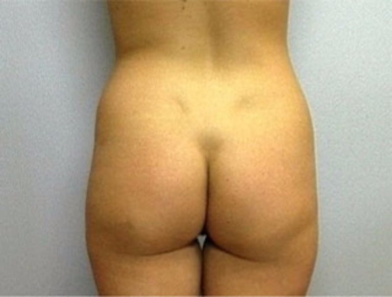 Liposuction Before & After Gallery - Patient 337119 - Image 1