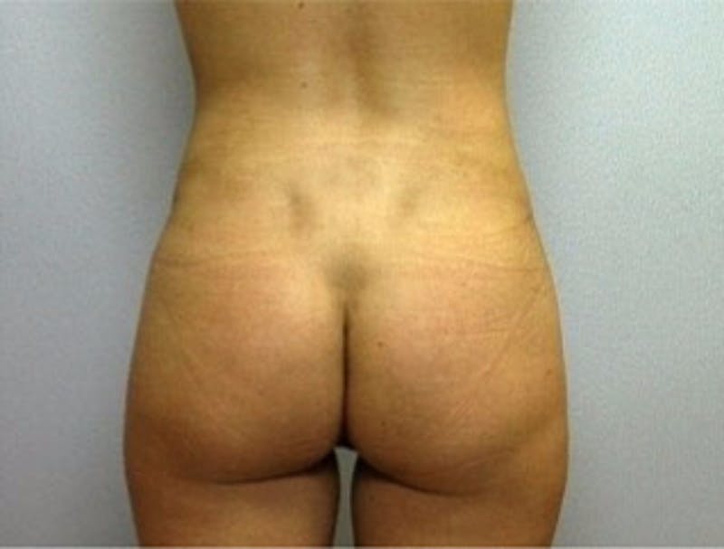Liposuction Before & After Gallery - Patient 337119 - Image 2