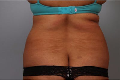 Liposuction Before & After Gallery - Patient 294105 - Image 1