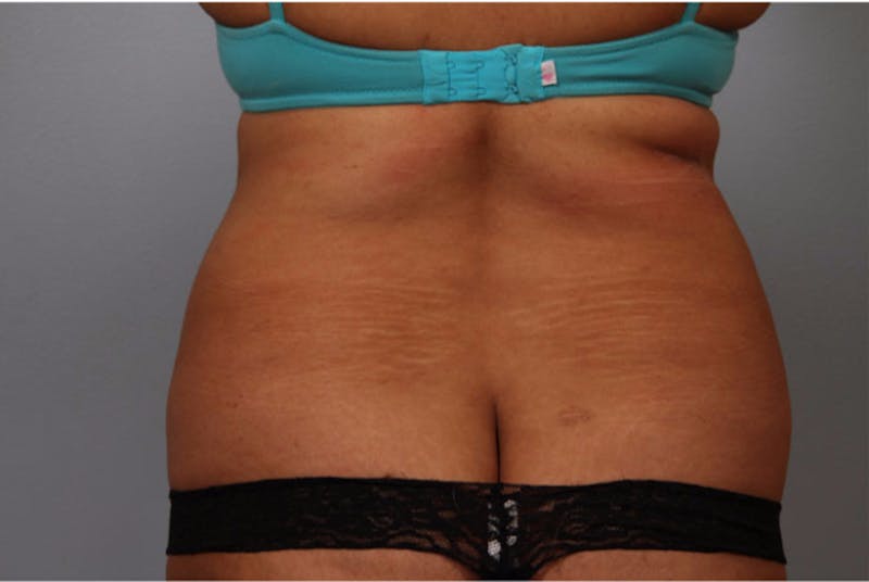 Liposuction Before & After Gallery - Patient 294105 - Image 1