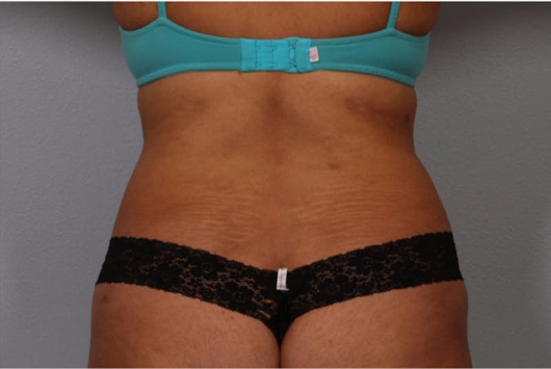 Liposuction Before & After Gallery - Patient 294105 - Image 2