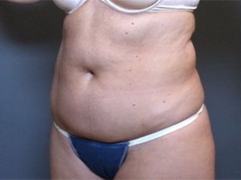 Mommy Makeover Before & After Gallery - Patient 477589 - Image 1