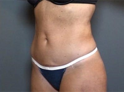 Mommy Makeover Before & After Gallery - Patient 477589 - Image 2