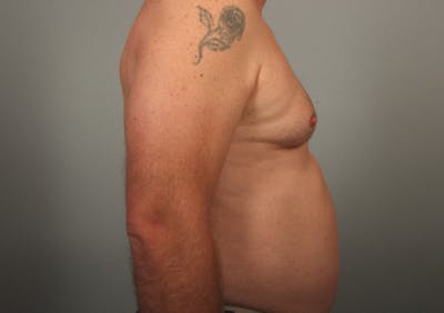 Male Body Contouring Before & After Gallery - Patient 176687 - Image 1